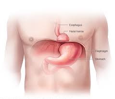 Hiatus Hernia