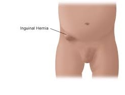 Inguinal Hernia
